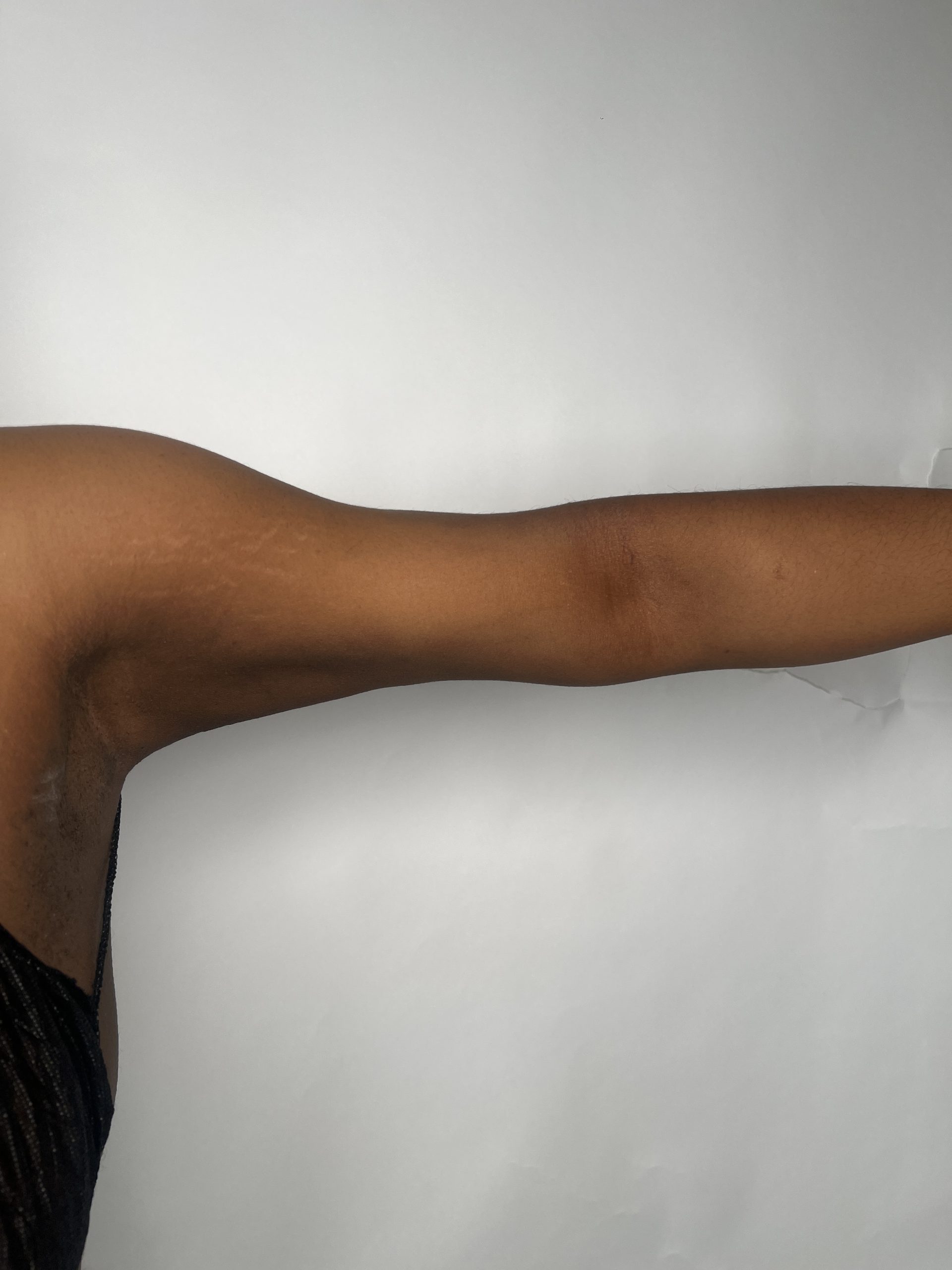 Arm Reduction after