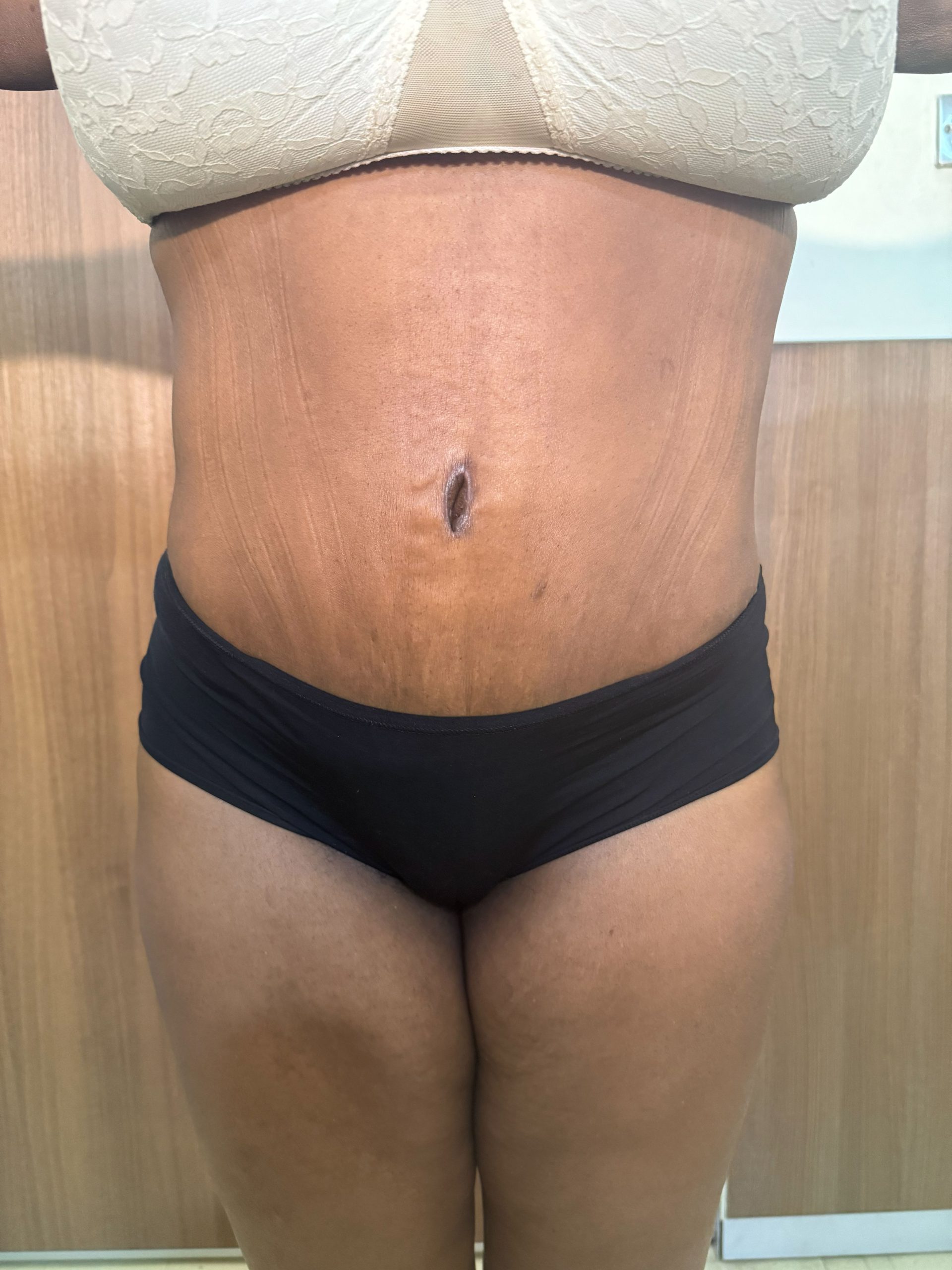 Tummy Tuck after