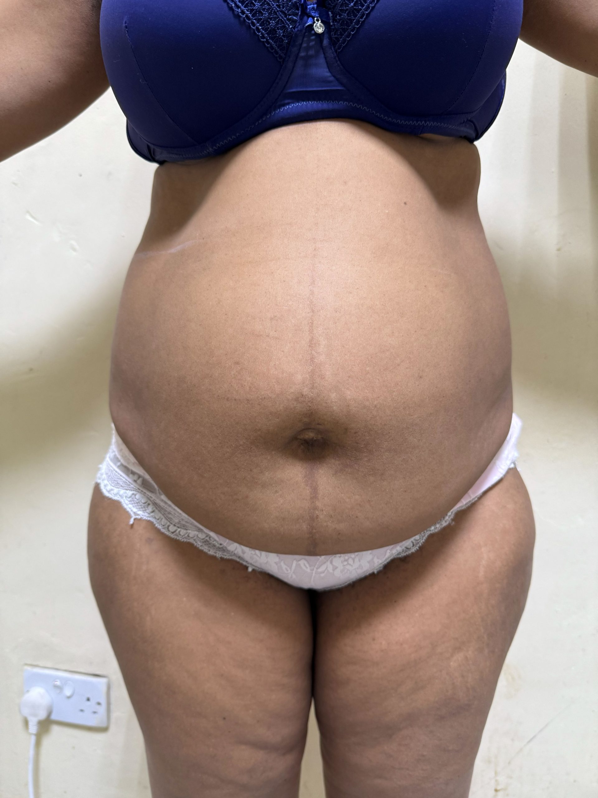 Tummy Tuck before