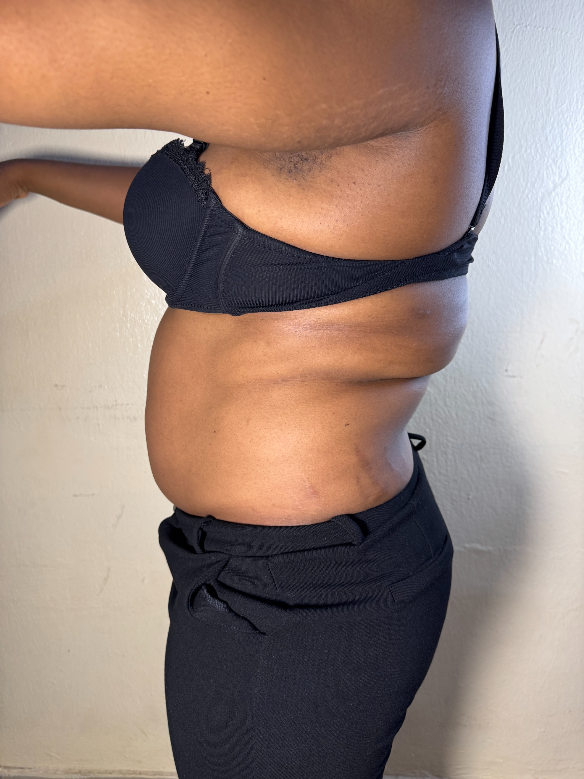 Male Liposuction