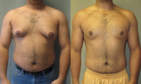 Male Breast Reduction (Gynecomastia)
